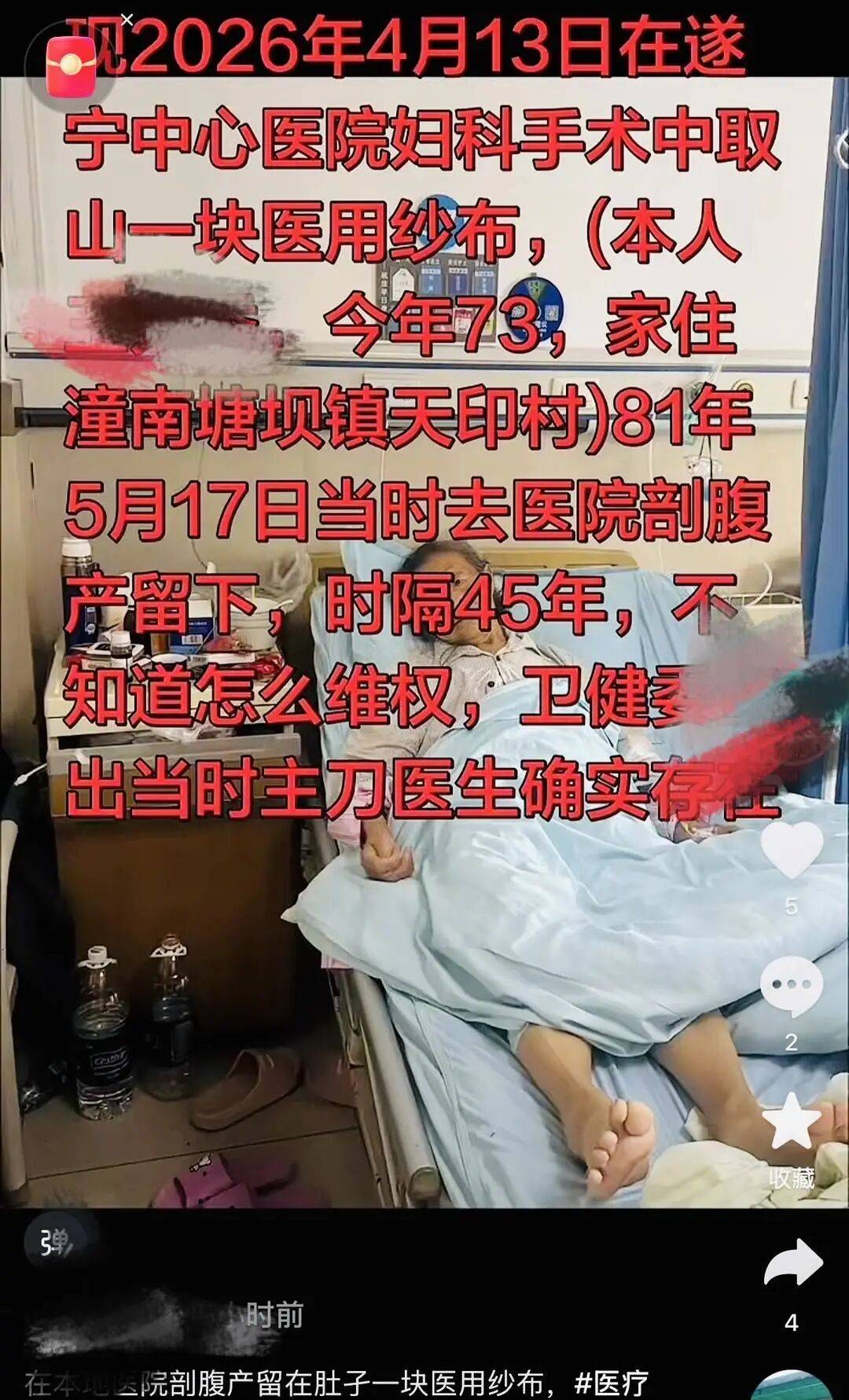 45年前纱布遗留体内?73岁老人体内取出“纱布样”腐朽异物,涉事医院已启动调查核实